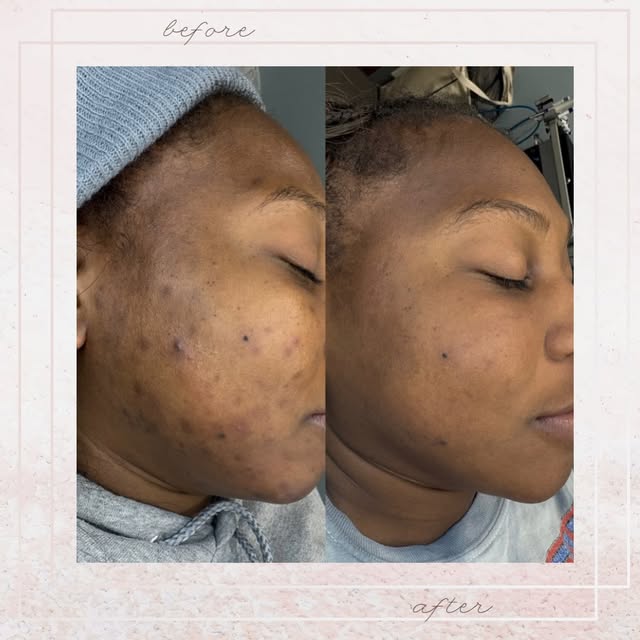4 PCA peels ✨
.
.
.
.
#chemicalpeel #pca #pcapeel #hyperpigmentation