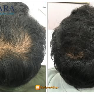 🌟 Patient Success Story – Vtiara Signature Hair Loss Treatment AT Vtiara Hair & Skin Clinic 🌟

• �