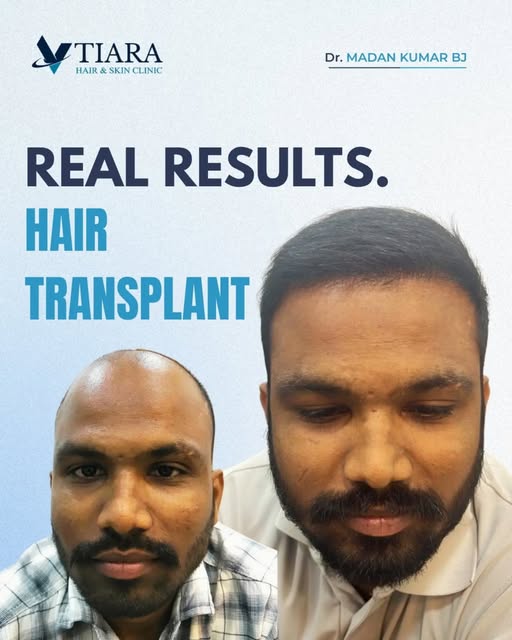 A hair restoration journey begins with the right diagnosis, realistic expectations and personalised 