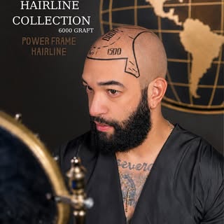 ✨ Power Frame Hairline | 6,000 Grafts Transformation
A natural appearance, a strong hairline, and ma