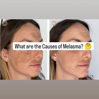 What is Melasma (पोतो /कालो दाग )?

Melasma is an acquired pigmentation in the face that affects bot