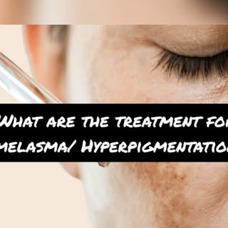 Treatment for melasma hyperpigmentation typically includes:

1. Topical Treatments
 - Hydroquinone: 