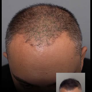 4 yıl sonra yeninden yaptığımız işlem…

4 yıl önce bizi hatalı işlem sebebiyle bizi ziyaret eden dan