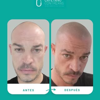 ✨ Un antes y después que habla por sí solo ✨
La micropigmentación capilar no solo transforma la apar