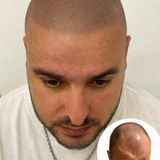 ¿Qué siente un cliente al realizarse una micropigmentación capilar?
Al principio, nervios y dudas. ¿