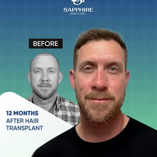 At Sapphire Hair Clinic, our goal is to provide hair transplant solutions that meet international st