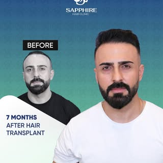 At Sapphire Hair Clinic, our goal is to provide hair transplant solutions that meet international st