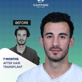 At Sapphire Hair Clinic, our goal is to provide hair transplant solutions that meet international st