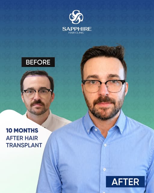 At Sapphire Hair Clinic, our goal is to provide hair transplant solutions that meet international st