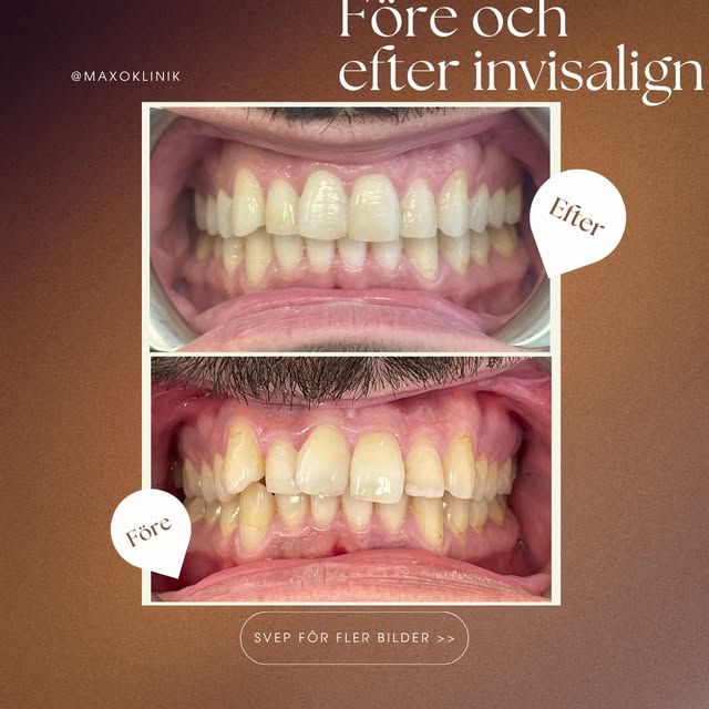 Ett leende kan förändras mer än du tror.

Här ser du ett före- och efterresultat med Invisalign hos 