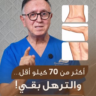 خسرت 72 كيلو… لكن الرحلة ما خلصت.

خسارة أكثر من 70 كيلو إنجاز كبير… لكن أحياناً الجلد الزائد يخلي ا