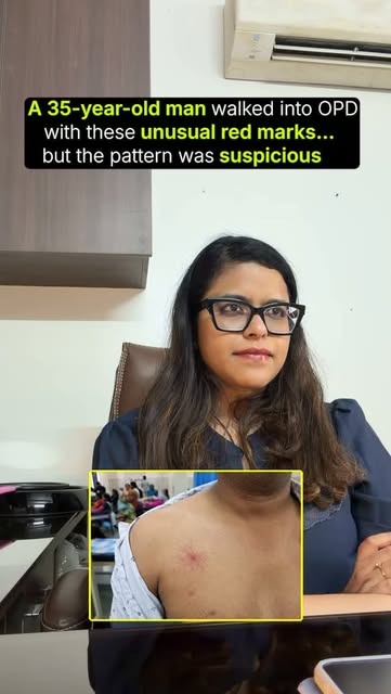 A 35-year-old man walked into OPD with these unusual red marks… but the pattern was suspicious. 👀


