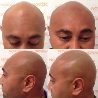 THIS IS WHAT I DO IS ALL ABOUT. Scalp Micropigmentation is a cosmetic tattoo stippling technique tha