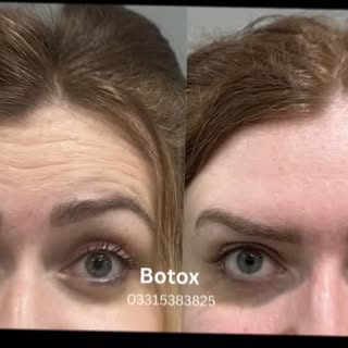 Wrinkles and fine lines making you look older than you feel? Smooth them out with our signature Boto