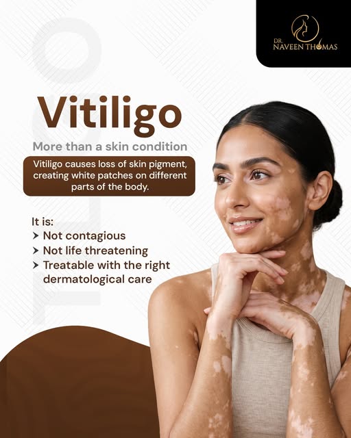 Vitiligo is more than just a change in skin colour. 🤍

It’s a condition that can affect anyone, but