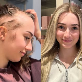Julia’s ⭐️⭐️⭐️⭐️⭐️ review- “I had the most wonderful experience at Continental Hair. I have alopecia