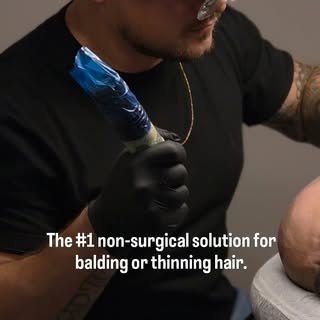 SMP - Micropigmentation for the scalp is a precise technique that replicates the look of natural hai