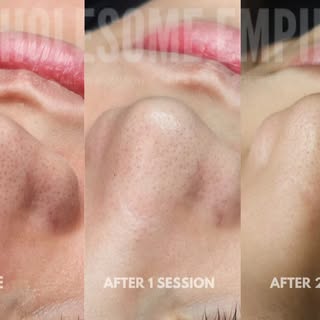 Scar revision isn’t one treatment - and it shouldn’t look the same for every person.

Every scar has