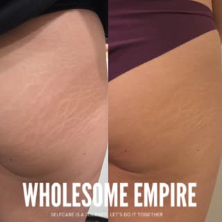 "My only regret is not doing this sooner.” 🥹 - Our client, after just two sessions of inkless stret