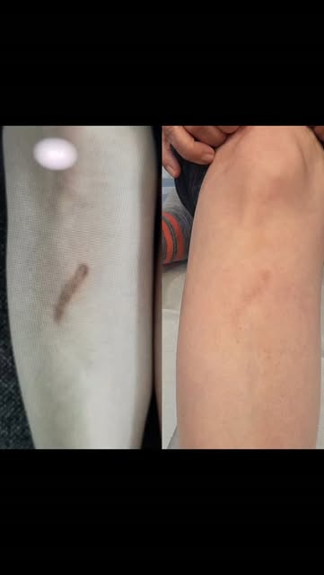 Whether your scar is newer or older, hyperpigmented or hypopigmented, you have options! And we would