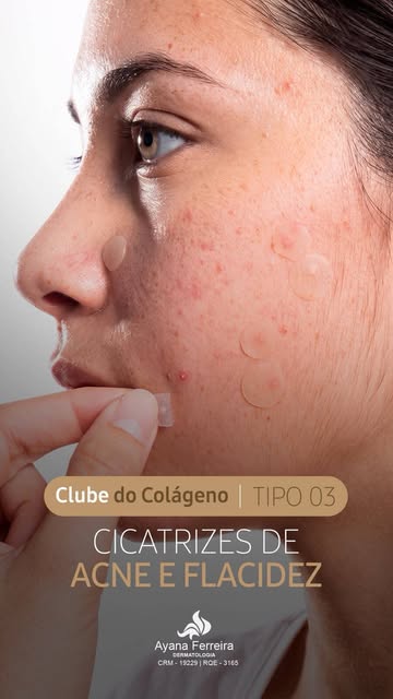 As cicatrizes de acne podem deixar marcas que vão além da superfície da pele.

Pensando nisso, criam