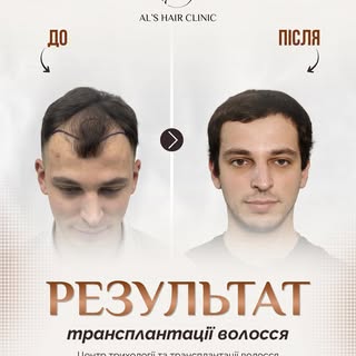 Ще один результат, який доводить: трансплантація волосся — це інвестиція у впевненість у собі.

Пере