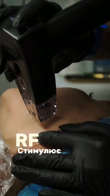 Чому мікроголковий RF іноді поєднують із біоревіталізацією?

Тому що ці процедури мають різні механі
