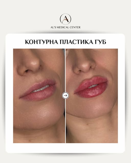 Контурна пластика губ — не завжди про більший об’єм. 

💳Ціна: від 5.600 грн

Іноді достатньо деліка