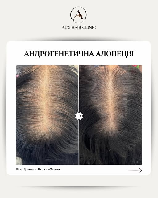 Андрогенетична алопеція — це не просто випадіння волосся.

При цьому стані волосся поступово стає то