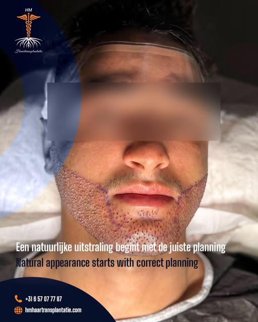 🧔‍♂️ Een natuurlijke uitstraling bij een baardtransplantatie begint met een juiste planning.

✨ Een