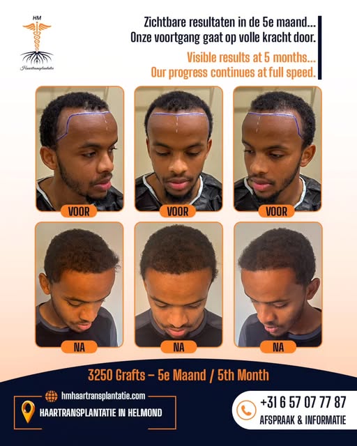 In de 5e maand al zichtbaar verschil! ✨

Het herstelproces na een haartransplantatie van 3250 grafts