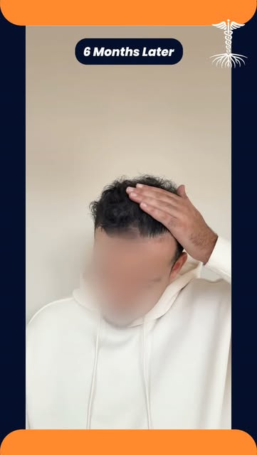 4.500 grafts – 6 maanden progressie ✨

Bij deze patiënt zijn 4.500 grafts getransplanteerd. In deze 