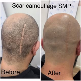 Scar camouflage SMP #hairtattoo #scalpmicropigmentation #hairpigmentation #baldnesstreatment #scartr