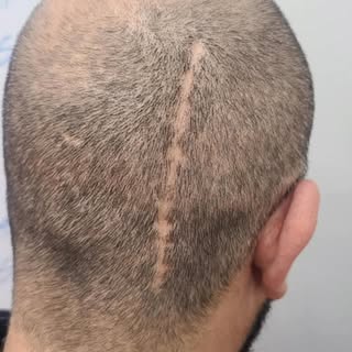 Scar Camouflage SMP Treatment #scar #hairtattoo #scartreatment #scalpmicropigmentation #hairpigmenta
