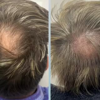 Hair loss solutions with SMP density treatments
#hairideas #hairtattoo #hairpigmentation #scalpmicro