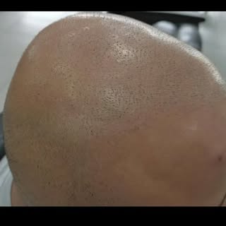 Before and after smp
#ScalpMicropigmentation
#SMPArtist
#SMPExpert
#SMPTransformation
#SMPResults
#S