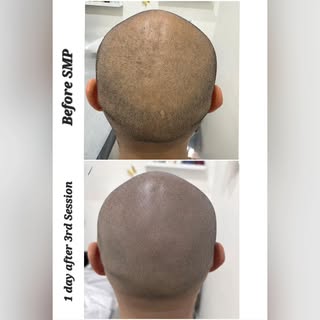Come check this!! SMP transformation. #hairlinerestoration #hairpigmentation #hairtransformation #ha
