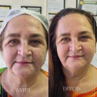 ✨ Resultado que transforma sem perder a naturalidade!

O famoso bigode chinês e a linha da marionete