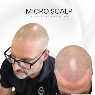 Il y a plusieurs années, un client m’a contactée pour une correction de micropigmentation capillaire