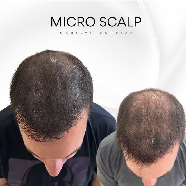 Suite à plusieurs greffes de cheveux, ce client ne voulait plus retourner en faire d’autres. Il m’a 