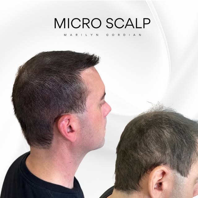 Camouflage de cicatrice après plusieurs greffes de cheveux 🫣