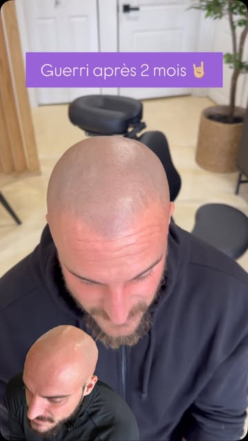 Voici un résultat guéri après 2 mois ☺️🤘🏼 

La Micropigmentation capillaire est un tatouage qui va