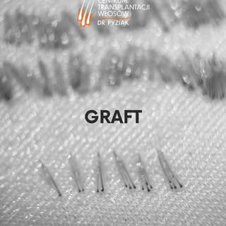 Czym jest „graft”? 🤔
Podczas przeszczepu włosów w technice FUE-DHI nie liczymy pojedynczych włosów 