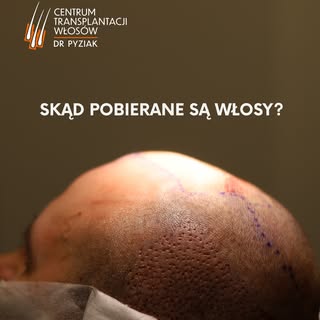 Podczas zabiegu metodą FUE włosy pobierane są z tzw. obszaru dawczego — najczęściej z tyłu i boków g