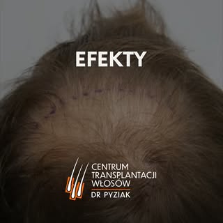 Prezentowane zdjęcia przedstawiają rzeczywistych pacjentów, którzy poddali się zabiegowi transplanta