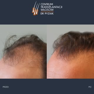 Prezentowane zdjęcia przedstawiają rzeczywistych pacjentów, którzy poddali się zabiegowi transplanta