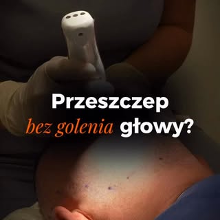 Przeszczep włosów bez maszynki? Tak, to możliwe! 🚫🪒

Wielu naszych pacjentów pyta: „Doktorze, czy 