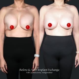 Sometimes the right results call for a refresh. This patient underwent an implant exchange with caps