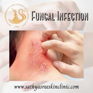 📞 9591 550 555

Common mistakes that can aggravate a fungal infection:

1. WEARING SWEATY OR WET CL