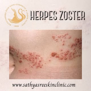📞 9591 550 555 

DOS & DON'TS FOR HERPES ZOSTER (SHINGLES)

1. Do keep your skin clean & rash uncov